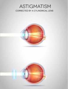 astigmatism Corrected