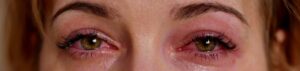 Conjunctivitis Inflamation